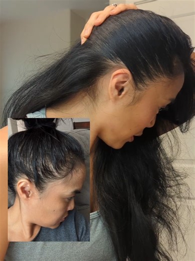 Maximize Hair Growth with 5% Minoxidil Benefits