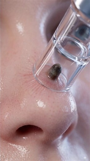 Blackhead Acne Vacuums Are Breaking Blood Vessels on Your Face🫢