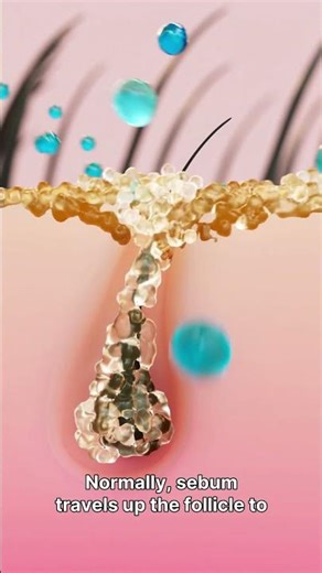 Module 1: What Is Acne? Beauty Therapist Training at The Derma Academy Germany and Uk