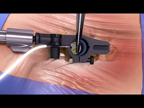 SOAR™ Retractor System