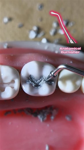 Mortada Mohammed on Instagram‎: "Class I amalgam restoration #dentistry #odontologia #odonto #طب_اسنان"‎