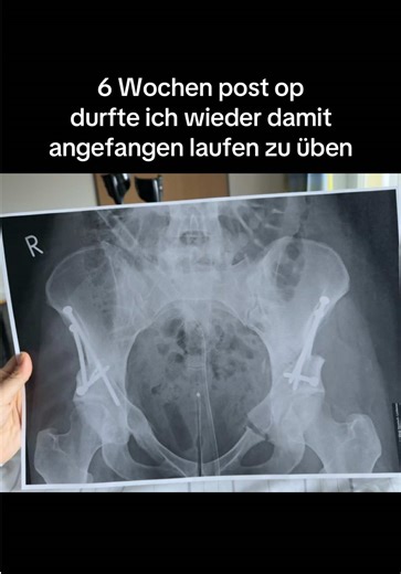 Pao Surgery Recovery: My Journey to Walking Again