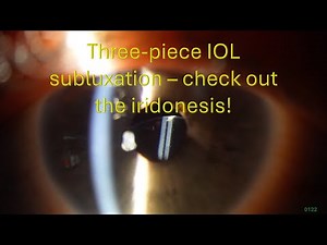 0122: Three-piece IOL subluxation - check out the iridodonesis!