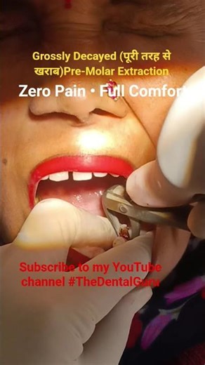 देखें पूरी तरह से खराब दांत को बिना दर्द निकलतेहुए GrosslyDecayed Premolar Extraction #TheDentalGuru