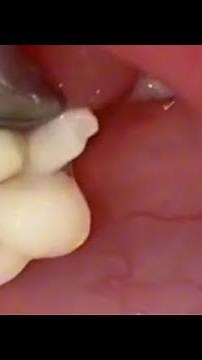 Caseum 😱 cáseos ou cases amigdalianos