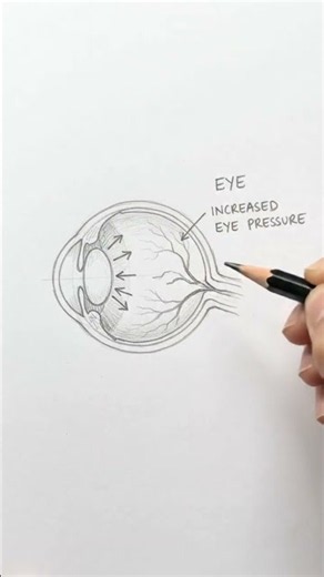 What Happens Inside Your Eye During Glaucoma?
