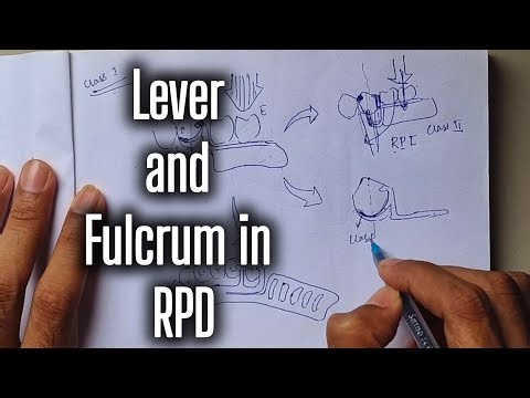 Lever & Fulcrum in RPD Made EASY 🔥 | Class I → Class II Concept Explained