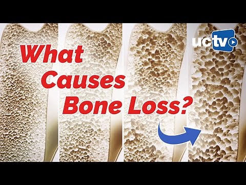 What Causes Bone Loss?