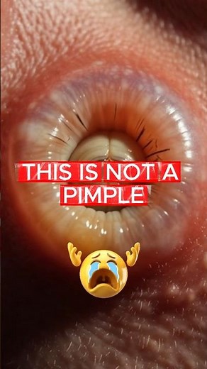 This Tropical Parasite Is Living Inside Thousands of People #botfly #parasite #realstory