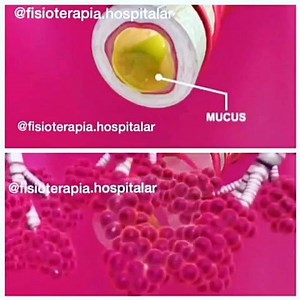 A asma é uma doença inflamatória crônica, caracterizada por hiperresponsividade das vias aéreas inferiores e por limitação variável ao fluxo aéreo, reversível espontaneamente ou com tratamento, manifestando-se clinicamente por episódios recorrentes de sibilância, dispnéia, aperto no peito e tosse, particularmente à noite e pela manhã ao despertar. Resulta da interação entre a carga genética, exposição ambiental a alérgenos e irritantes, e outros fatores específicos que levam ao desenvolvimento e