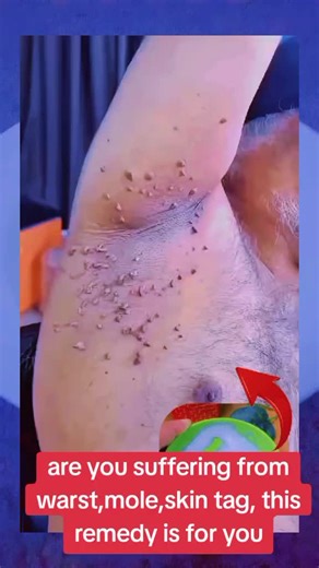 Natural Remedies for Skin Tags and Warts Using DIY Methods