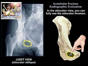 Acetabular Fracture Radiographic Evaluation  • Video • MEDtube.net