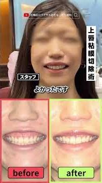 患者様インタビュー(ガミースマイル)【北梅田ロワイヤルおとなこども歯科】 #歯医者#審美歯科#大阪歯医者#美容#dentist #歯医者 #美容 #整形