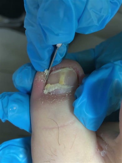 First Trim The Ingrown Nail, Then Remove The Dead Skin #satisfying