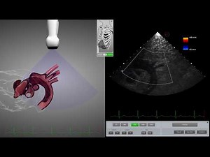 HeartWorks Aortic Dissection