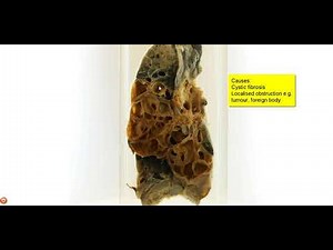 Lung: Bronchiectasis