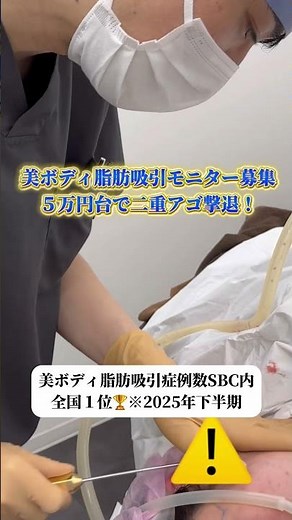 二重アゴとあご下のもたつきは脂肪吸引で解決！イテウォン恵比寿院、後迫医師にお任せください😊 #ダウンタイム #美容整形 #脂肪吸引