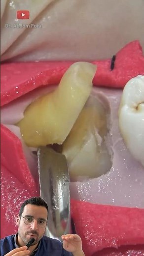 La SAGESSE incluse, comment extraire cette dent ?