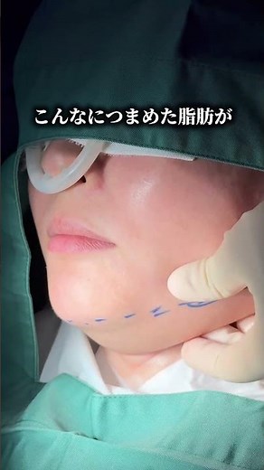 顎下脂肪吸引注射💉術直後症例✨#脂肪吸引 #脂肪吸引注射 #整形 #小顔