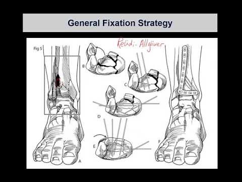 Tibial pilon fractures 2