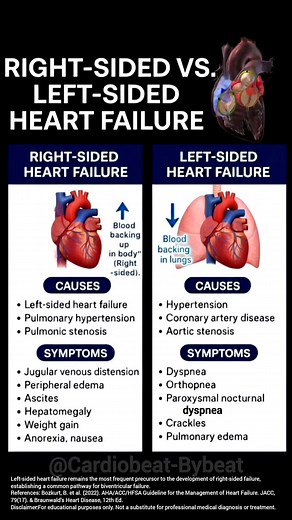 64K views · 392 reactions | Right vs. Left-Sided Heart Failure: Right-Sided HF: Impaired RV output → Systemic venous congestion. Left-Sided HF: Impaired LV output → Pulmonary venous congestion. #HeartFailure #Cardiology #MedEd #MedicalEducation | Cardiobeat-bybeat | Facebook