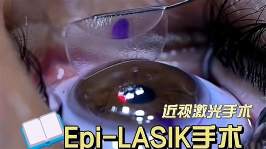近视眼Epi-LASIK手术：Epipolis Laser In Situ Keratomileus