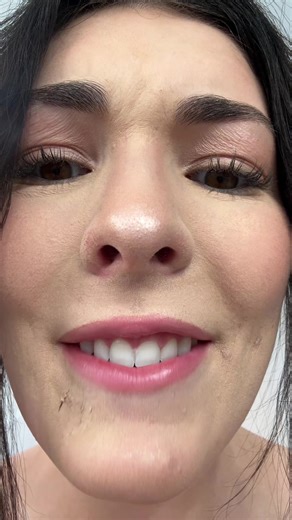 Wedding Day Skin Mishap: My Face Peeling Experience