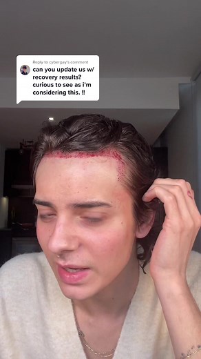 Men's Neograft Hair Transplant: Ryan Bailey Potter Before and After