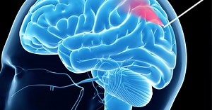 Video Shows Innovative "Brain Needle" With a Surprise Feature