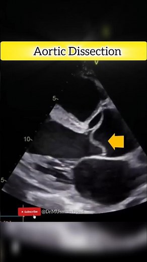 Aortic Dissection on Echocardiogram #echocardiography #heart #heartcondition