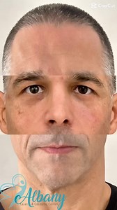 ✨ Full Face Rejuvenation with Bellafill® & Belotero® – Look Refreshed, Naturally! ✨ We’re excited to share this 3-month transformation after full-face augmentation with Bellafill® and Belotero®! Our client wanted to restore volume, enhance facial contours, and brighten under-eye hollows without looking overdone. By combining Bellafill® to restore structure and Belotero® to refresh the under-eyes, we achieved a balanced, natural result that enhances his features. 💉 Bellafill®: Volume, Lift, and 