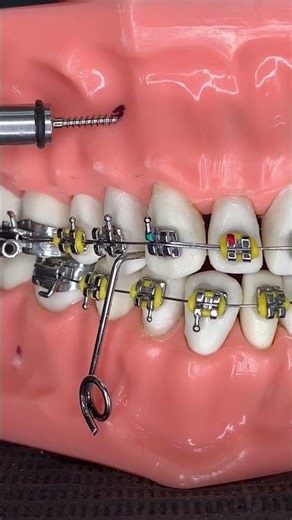 🔥Orthodontic Micro/Implant Installation🔥