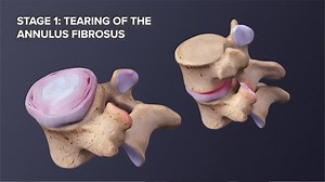 Degenerative Disc Disease Progression over Time