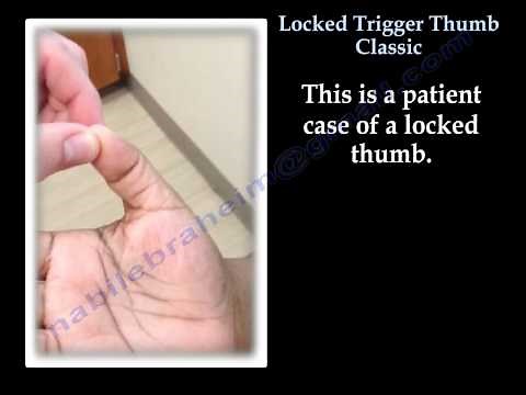 locked Trigger Thumb Classic - Everything You Need To Know - Dr. Nabil Ebraheim