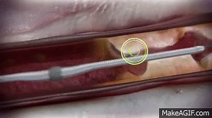 Diamondback 360® Coronary Orbital Atherectomy System (OAS) on Make a GIF