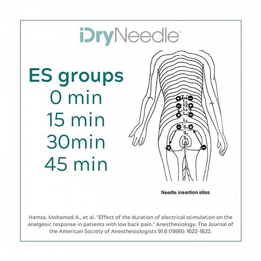 "How long should I use e-stim with dry needling?" - iDryNeedle research short