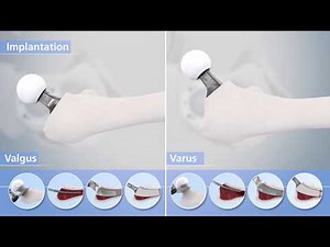 Mathys: Implantation des kalkargeführten optimys Schaftes