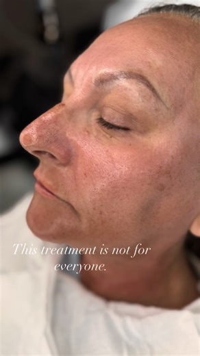 This treatment is not for everyone. It’s for you if: – you want real skin change, not temporary glow – you’re ready for healing, not shortcuts – you understand results take time It’s not for you if: – you want instant perfection – you avoid downtime – you skip aftercare Right now is actually the best period for this treatment. Less sun. More cloudy days. Lower UV exposure. That’s exactly when CO₂ works best. To make sure it’s right for you, consultation and patch test are free. — Treatment shown