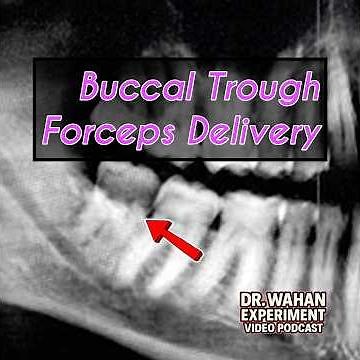 Erupted Wisdom Tooth Extraction