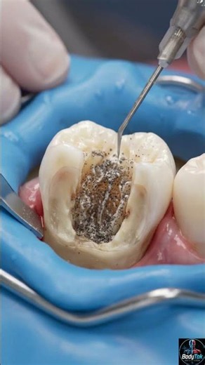 How Dentists Treat Tooth Infections ?