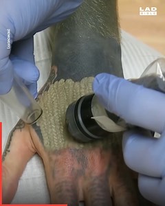 18K views · 27 reactions | The process of tattoos getting removed is so satisfying ⚡️ | Do It Yourself | Facebook