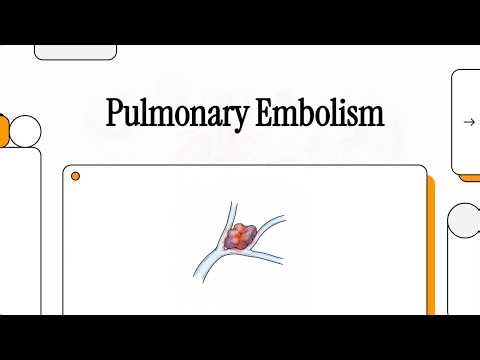 MET - 78 - Pulmonary Embolism - Explainer Video
