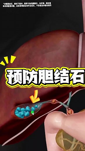 膽結石的形成原因與預防方法