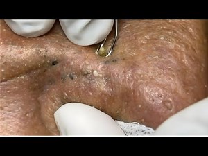 Blackhead Removal: Satisfying Routine | 125