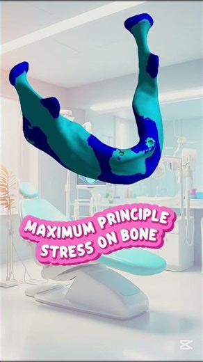 Biomechanical Engineering Precision in Implant Supported Dentures | Imaging to Simulation