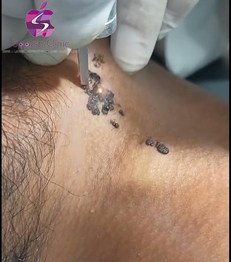 VERRUCOUS EPIDERMAL NEVUS REMOVAL BY CO2 LASER.#VerrucousNevusRemoval#CO2LaserTreatment