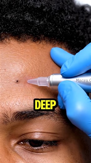 This Pimple Pop Started a CONTAGIOUS Chain Reaction on His Face!