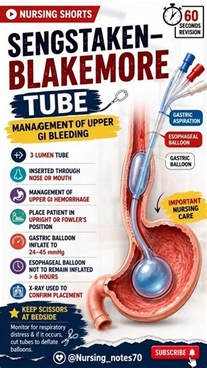 Sengstaken–Blakemore Tube Explained in 60 Seconds | Upper GI Bleeding | Nursing Notes