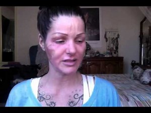 4 days post procedure. Total FX CO2 Fractional skin resurfacing laser treatment.