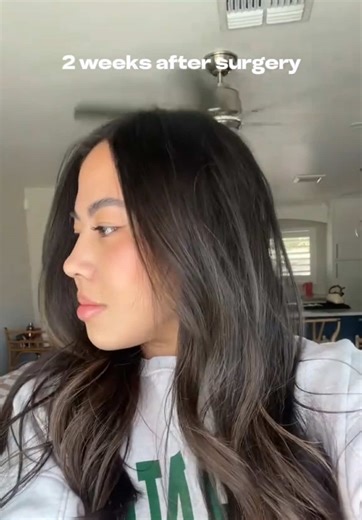 Rhinoplasty Journey: 1 Week Pre-Op to 2 Weeks Post-Op